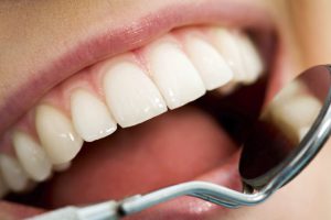 Wisdom Teeth in Chicago IL